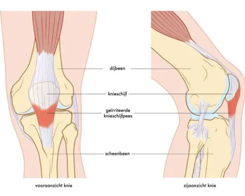 Meest voorkomende hardloopblessures jumpers knee