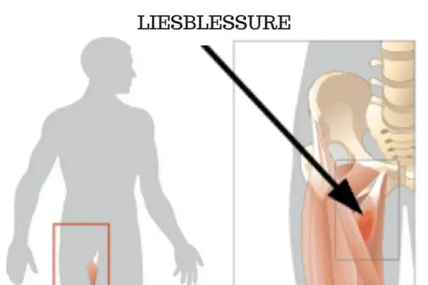 meest voorkomende hardloopblessures liesblessure