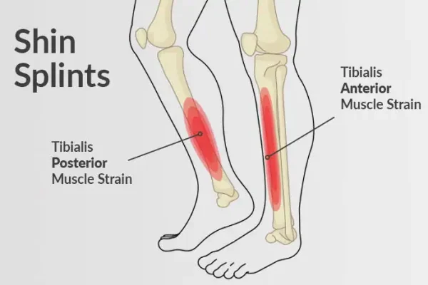 Meest voorkomende hardloopblessures shin splint